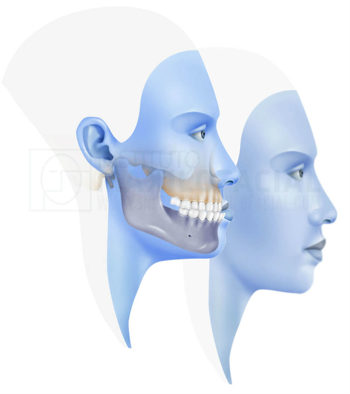 Prognatismo Mandibular o Clase 3 » Cirugía Ortognática - Instituto,  mandibula e maxilar 